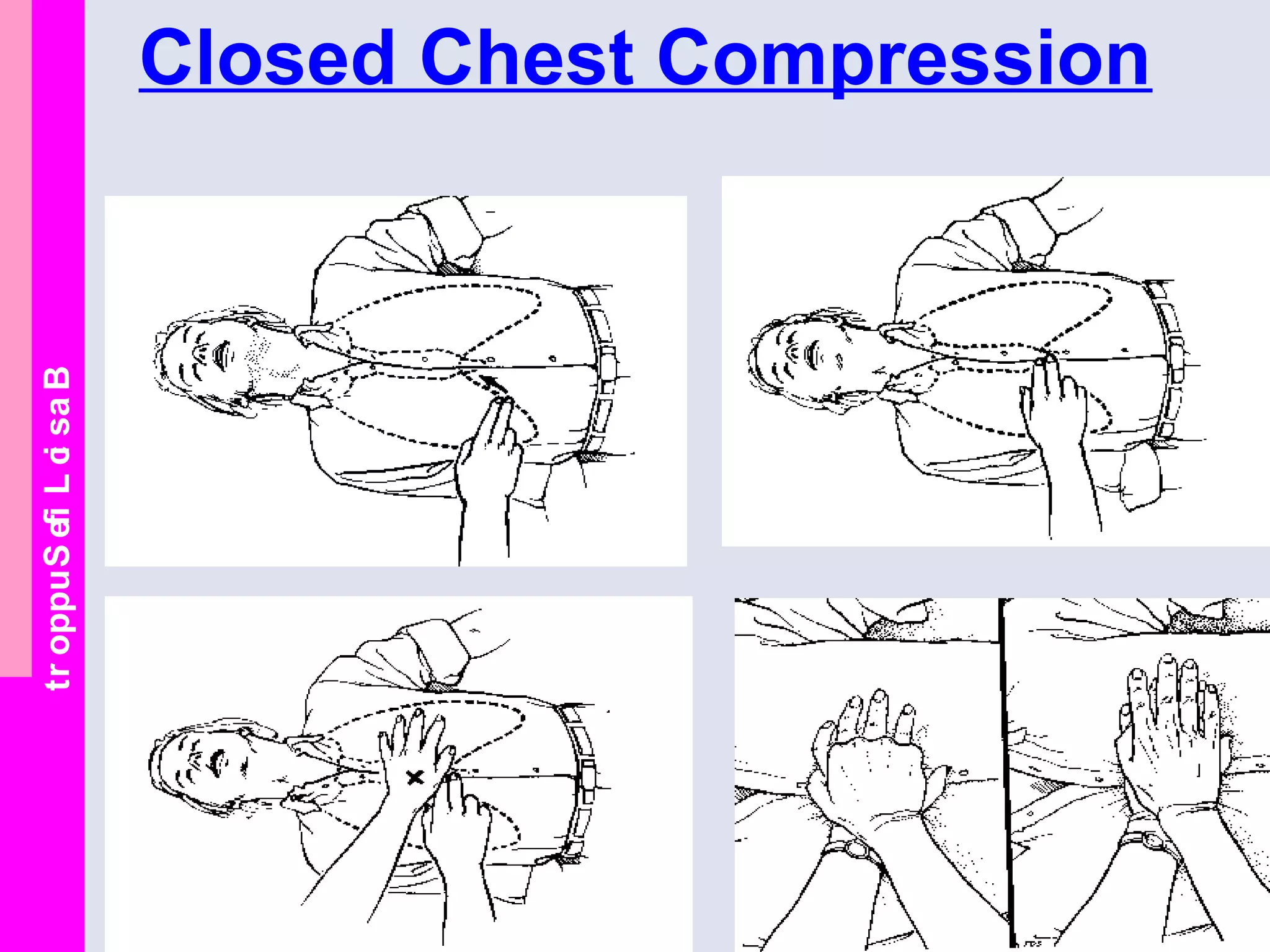 BasicLifeSupport Closed Chest Compression
 