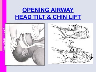 BasicLifeSupport
OPENING AIRWAY
HEAD TILT & CHIN LIFT
 