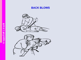 BasicLifeSupport
BACK BLOWS
 