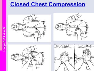 BasicLifeSupport Closed Chest Compression
 
