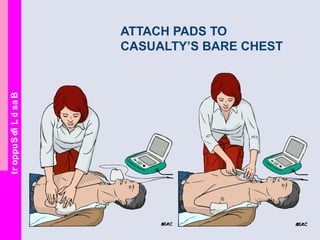 BasicLifeSupport
ATTACH PADS TO
CASUALTY’S BARE CHEST
 