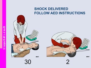 BasicLifeSupport
SHOCK DELIVERED
FOLLOW AED INSTRUCTIONS
30 2
 