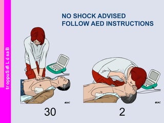 BasicLifeSupport
NO SHOCK ADVISED
FOLLOW AED INSTRUCTIONS
30 2
 