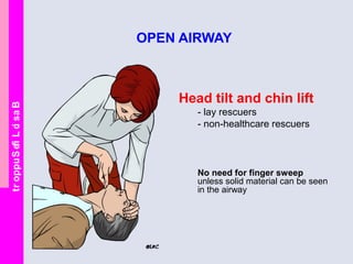 BasicLifeSupport
OPEN AIRWAY
Head tilt and chin lift
- lay rescuers
- non-healthcare rescuers
No need for finger sweep
unless solid material can be seen
in the airway
 