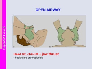BasicLifeSupport
OPEN AIRWAY
Head tilt, chin lift + jaw thrust
- healthcare professionals
 