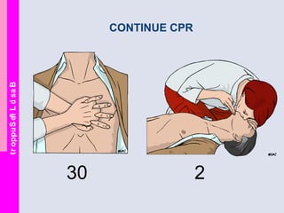 BasicLifeSupport
CONTINUE CPR
30 2
 