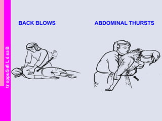 BasicLifeSupport
BACK BLOWS ABDOMINAL THURSTS
 