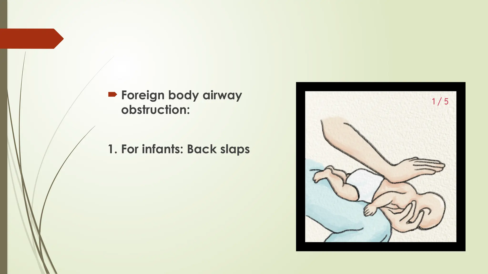  Foreign body airway
obstruction:
1. For infants: Back slaps
 