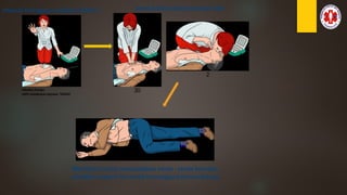 Muncul Peringatan Indikasi SHOCK !!
•Hindari Pasien
•AED melakukan kejutan ‘SHOCK’
Setelah Shock ikuti petunjuk AED
30
2
Bila Pasien mulai menunjukkan tanda –tanda bernafas
posisikan seperti ini sambil menunggu bantuan datang
 