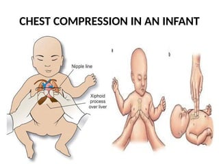 CHEST COMPRESSION IN AN INFANT
 