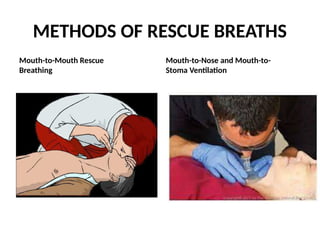 METHODS OF RESCUE BREATHS
Mouth-to-Mouth Rescue
Breathing
Mouth-to-Nose and Mouth-to-
Stoma Ventilation
 