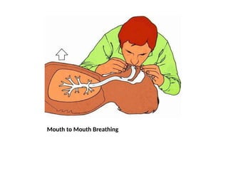 Mouth to Mouth Breathing
 