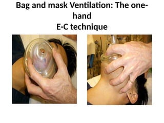 Bag and mask Ventilation: The one-
hand
E-C technique
 