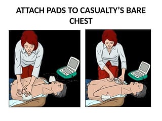 ATTACH PADS TO CASUALTY’S BARE
CHEST
 