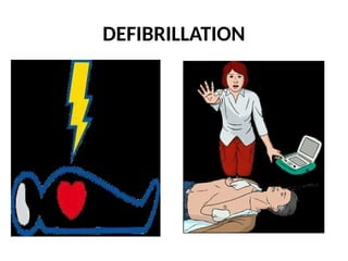 DEFIBRILLATION
 