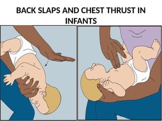 BACK SLAPS AND CHEST THRUST IN
INFANTS
 