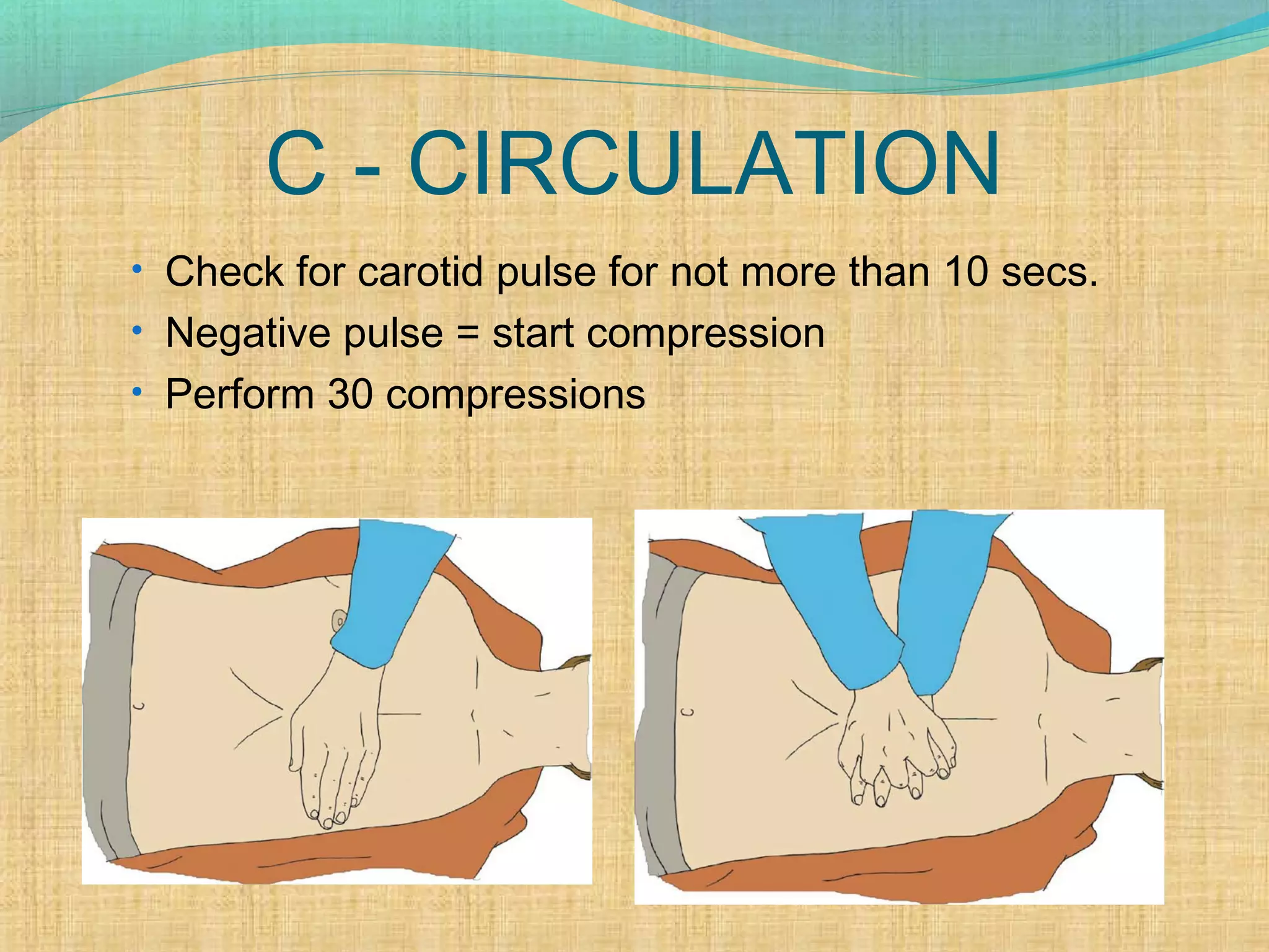 C - CIRCULATION
• Check for carotid pulse for not more than 10 secs.
• Negative pulse = start compression
• Perform 30 compressions
 