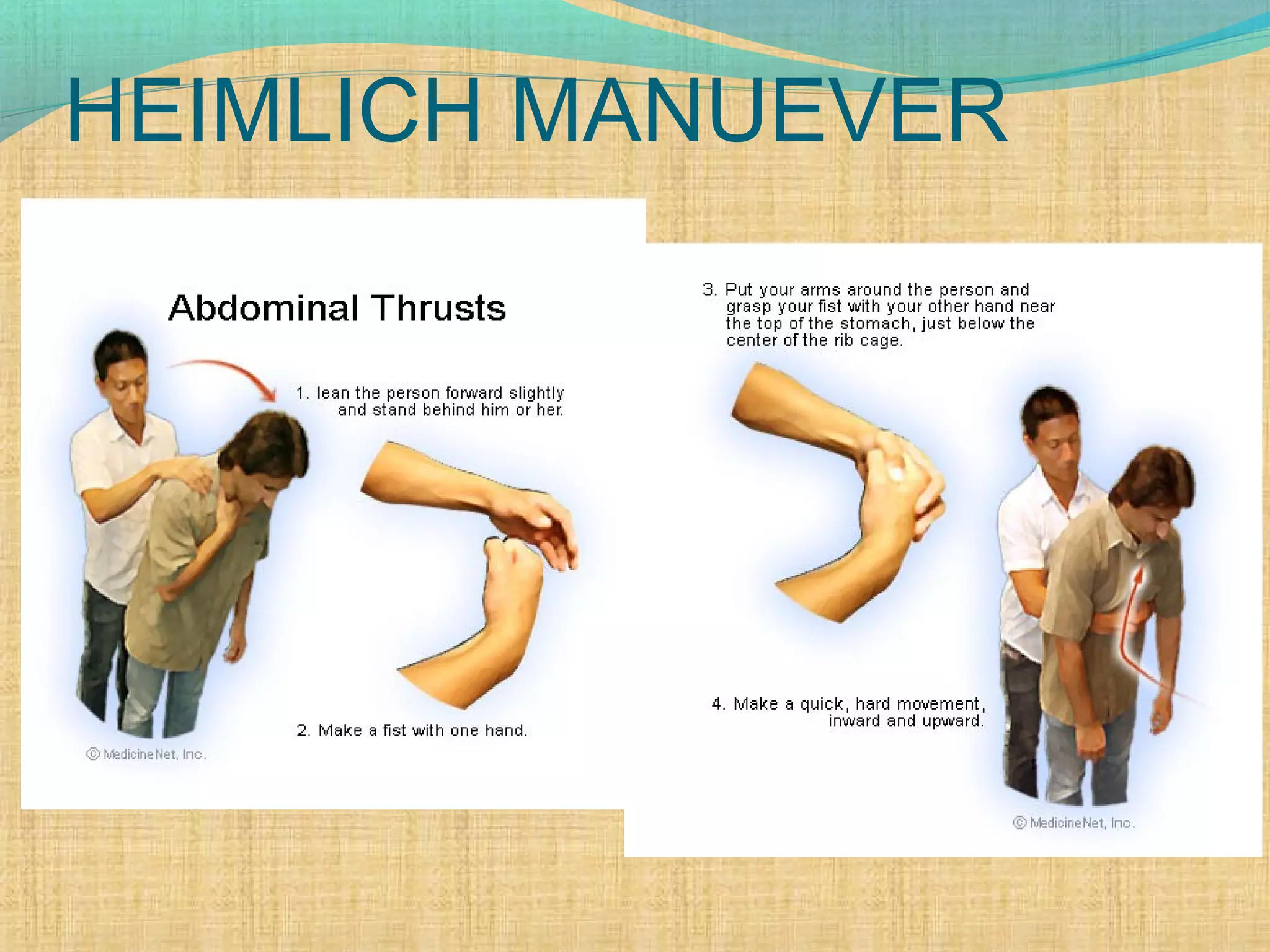 HEIMLICH MANUEVER
 