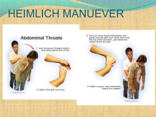 HEIMLICH MANUEVER
 