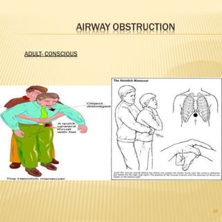 AIRWAY OBSTRUCTION
ADULT- CONSCIOUS
26
 