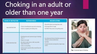 Choking in an adult or
older than one year
 