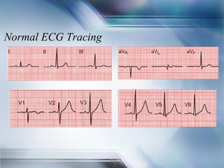 Normal ECG Tracing
 