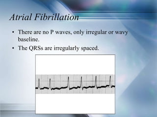 Atrial Fibrillation
• There are no P waves, only irregular or wavy
baseline.
• The QRSs are irregularly spaced.
 