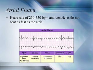Atrial Flutter
• Heart rate of 250-350 bpm and ventricles do not
beat as fast as the atria
 