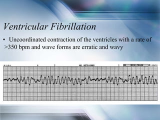 Ventricular Fibrillation
• Uncoordinated contraction of the ventricles with a rate of
>350 bpm and wave forms are erratic and wavy
 