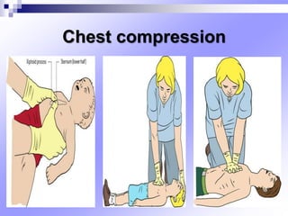 Chest compression
 