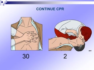 CONTINUE CPR
2
30
 