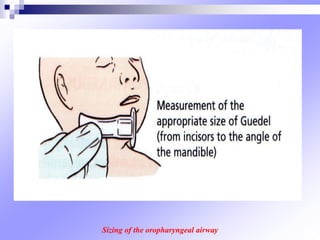 Sizing of the oropharyngeal airway
 