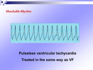 ShockableRhythm
Pulseless ventricular tachycardia
Treated in the same way as VF
 