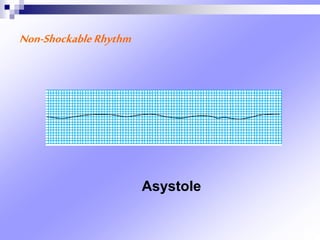 Non-ShockableRhythm
Asystole
 