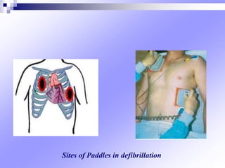 Sites of Paddles in defibrillation
 