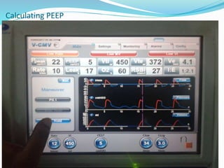 Calculating PEEP
 