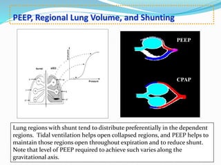 PEEP, Regional Lung Volume, and Shunting
PEEP
CPAP
Lung regions with shunt tend to distribute preferentially in the dependent
regions. Tidal ventilation helps open collapsed regions, and PEEP helps to
maintain those regions open throughout expiration and to reduce shunt.
Note that level of PEEP required to achieve such varies along the
gravitational axis.
 