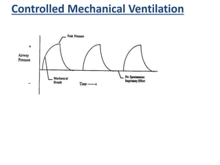 Controlled Mechanical Ventilation
 
