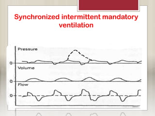 Synchronized intermittent mandatory
ventilation
Stacking
 
