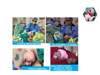ROUTINE CARE
BABIES WHO CRY AT BIRTH REQUIRE ROUTINE CARE
Initiate breastfeeding
Keep mother and baby
covered and observe
breathing and colour
Continue skin to skin care Cut cord within 1‐3 minutes
3
 