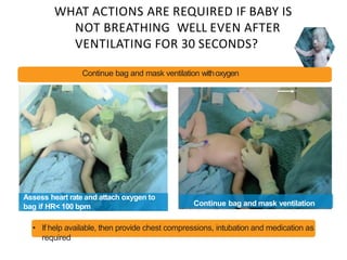 WHAT ACTIONS ARE REQUIRED IF BABY IS
NOT BREATHING WELL EVEN AFTER
VENTILATING FOR 30 SECONDS?
Continue bag and mask ventilation withoxygen
Continue bag and mask ventilation
Assess heart rate and attach oxygen to
bag if HR< 100 bpm
• If help available, then provide chest compressions, intubation and medication as
required
 