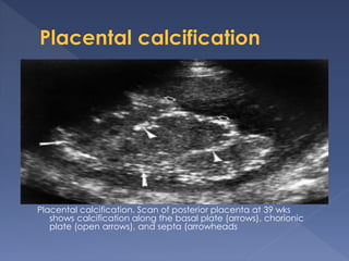 Placental calcification. Scan of posterior placenta at 39 wks
shows calcification along the basal plate (arrows), chorionic
plate (open arrows), and septa (arrowheads
 