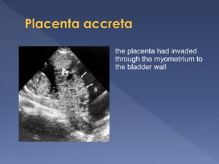 the placenta had invaded
through the myometrium to
the bladder wall
 