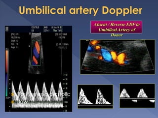  Positive end diastolic
 flow
Absent / Reverse EDF in
Umbilical Artery of
Donor
 