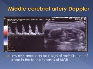  Low resistance can be a sign of redistribution of
blood in the foetus in cases of IUGR
 