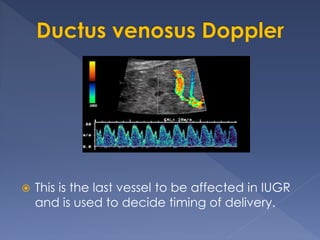  This is the last vessel to be affected in IUGR
and is used to decide timing of delivery.
 