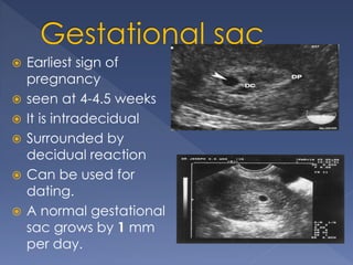  Earliest sign of
pregnancy
 seen at 4-4.5 weeks
 It is intradecidual
 Surrounded by
decidual reaction
 Can be used for
dating.
 A normal gestational
sac grows by 1 mm
per day.
 