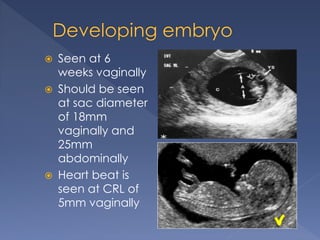  Seen at 6
weeks vaginally
 Should be seen
at sac diameter
of 18mm
vaginally and
25mm
abdominally
 Heart beat is
seen at CRL of
5mm vaginally
 