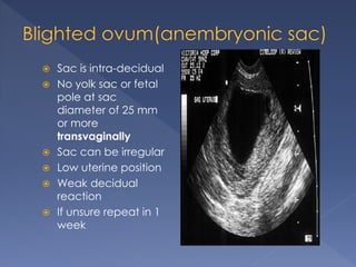  Sac is intra-decidual
 No yolk sac or fetal
pole at sac
diameter of 25 mm
or more
transvaginally
 Sac can be irregular
 Low uterine position
 Weak decidual
reaction
 If unsure repeat in 1
week
 