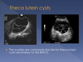  The ovaries are commonly the site for theca lutein
cysts secondary to the BHCG.
 